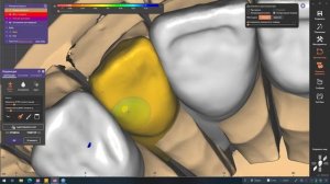 Последовательная дезокклюзия с Artex CR за час