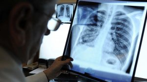 Боль в плече у мужчины оказалась симптомом рака легких