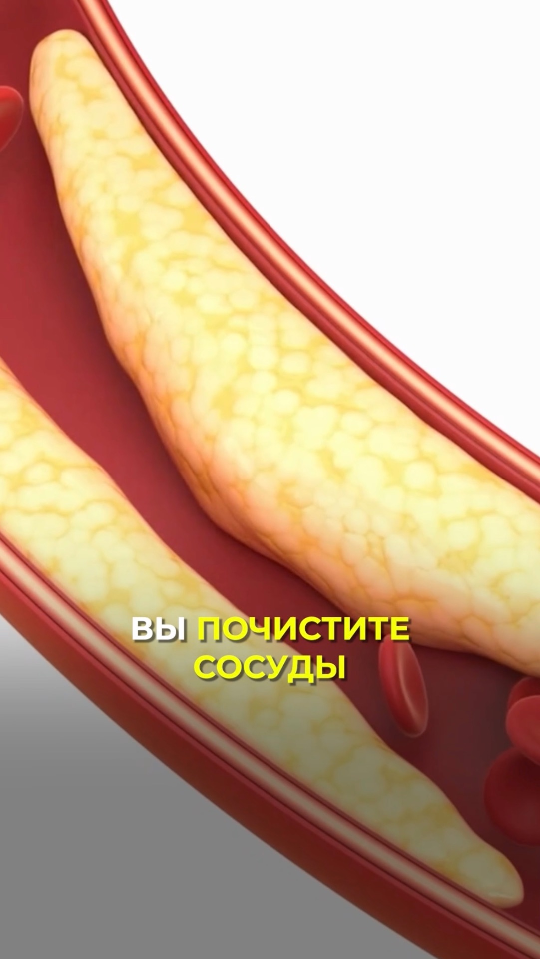 5 шагов, чтобы остановить рост бляшек