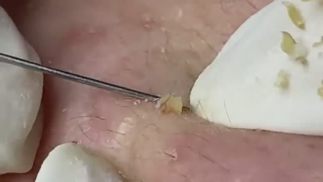 Relax Spa 034 • АСМР • Acne collection смотреть онлайн