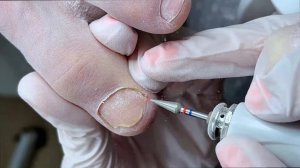 онихолизис НЕ ОТРАСТАЕТ после обработки!  так только кажется, в конце видео есть результат до/после