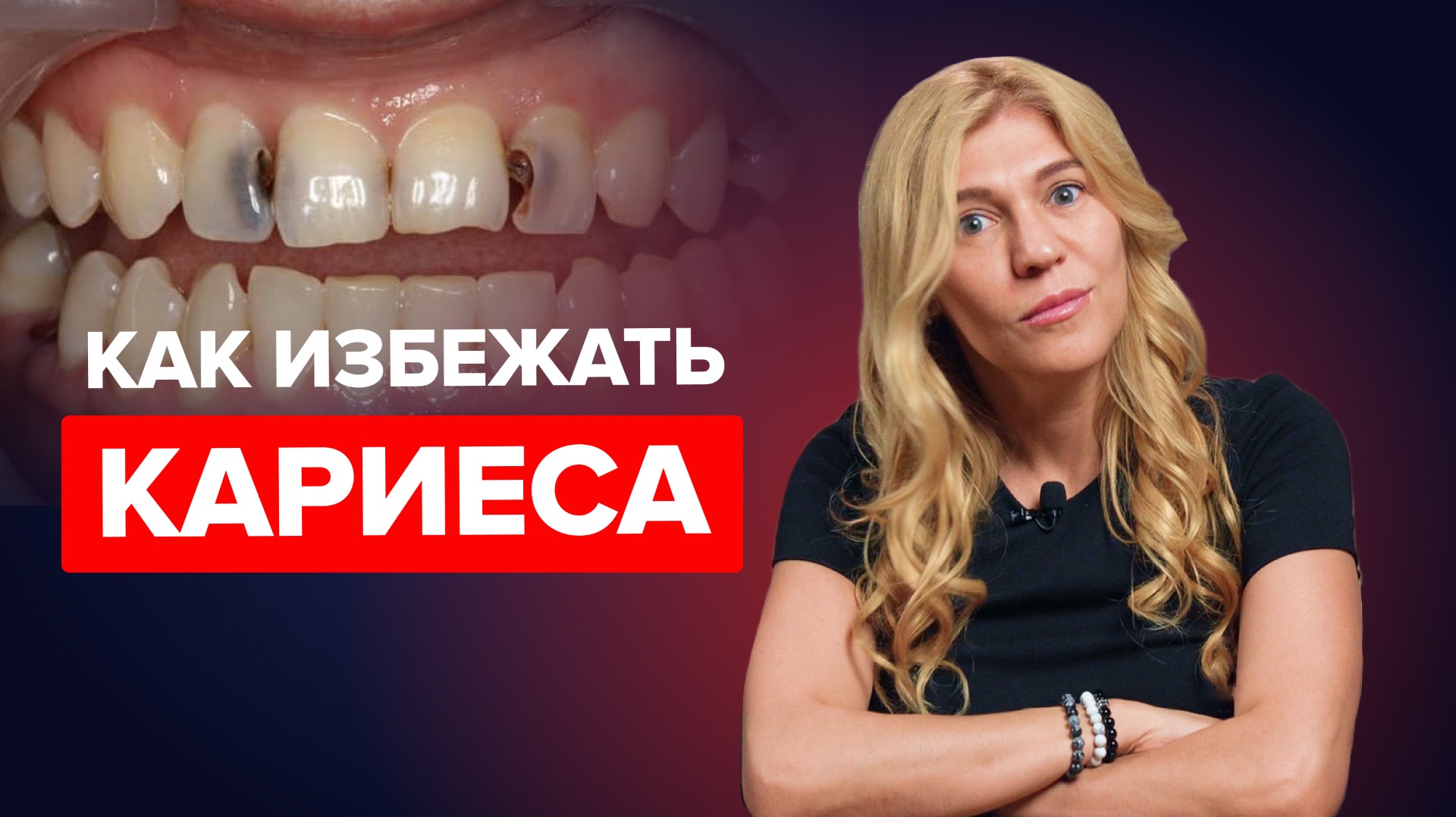 КАК ИЗБЕЖАТЬ КАРИЕСА?  Почему на самом деле образуется кариес?