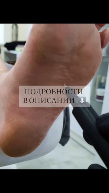 Холодная плазма в подологии: инструмент, которого вам не хватало! Холодная плазма в подологии: инструмент, которого вам не хватало!