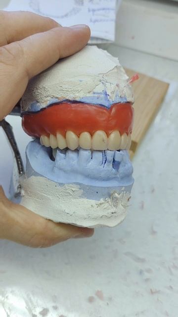 Съёмный протез на верхнюю челюсть.