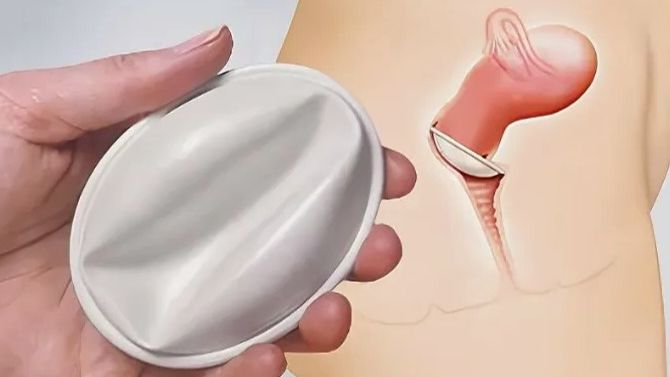 Диафрагма контрацептив смотреть онлайн