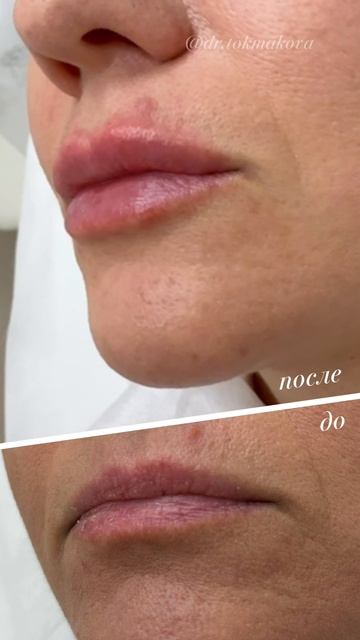 омоложение губ смотреть онлайн