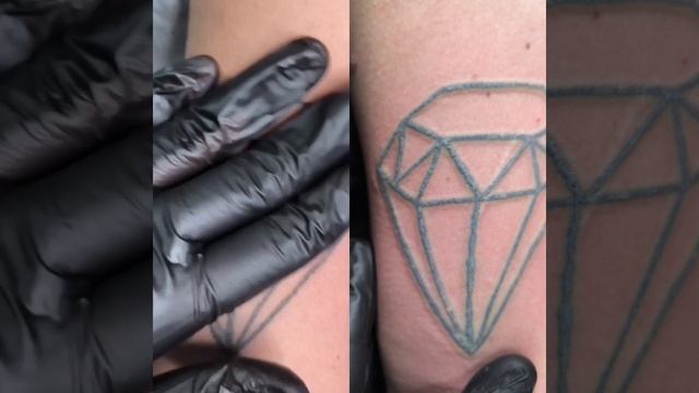 Лазерное удаление