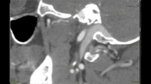 КТ анатомия головы