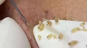 Выдавливание прыщей, угрей, черных точек и камедонов #96