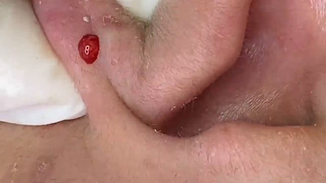 Выдавливание прыщей, угрей, черных точек и камедонов #97