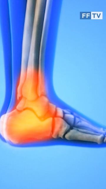 КАКИЕ РИСКИ ВОЗНИКНОВЕНИЯ ВАЛЬГУСНОЙ ДЕФОРМАЦИИ СТОПЫ #здоровье #медицина #вальгус #shorts