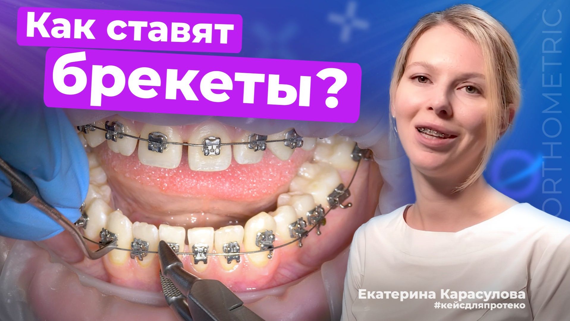 Как устанавливают современные самолигирующие брекеты?