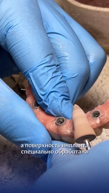 Почему импланты All-on-4 приживаются в 99% случаев