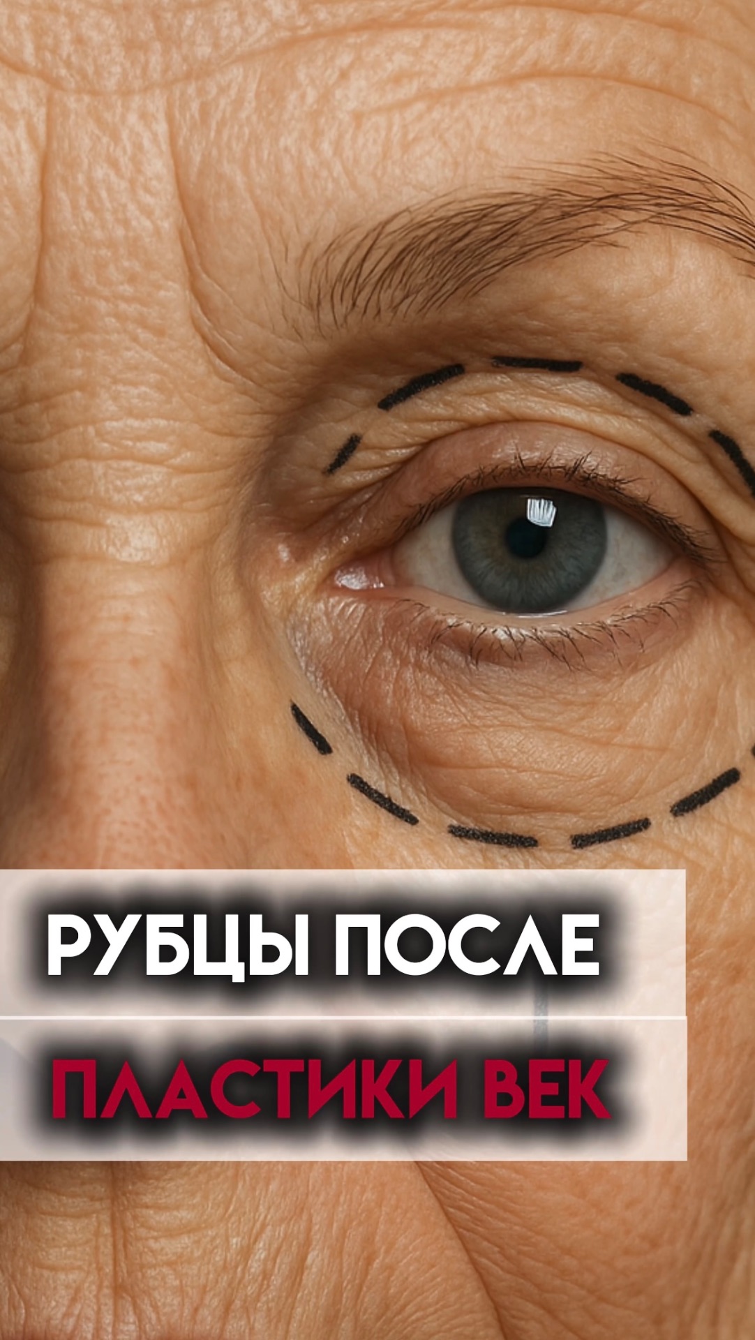 Остаются ли рубцы после пластики век? смотреть онлайн