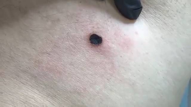 Удаление кератоакантомы