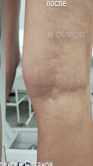 Лечение варикоза: лазер, склеротерапия. Флеболог Алексей Суханов