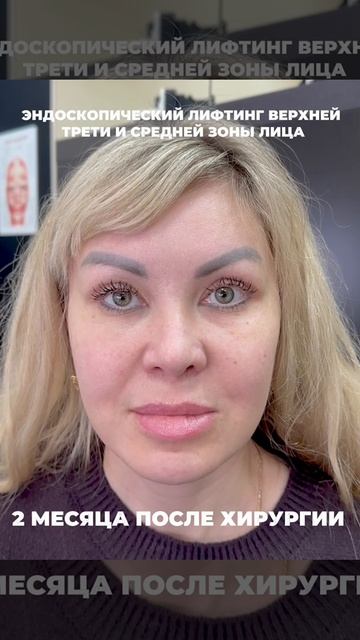 Эндоскопической безрубцовая подтяжка верхней трети и средней зоны лица
