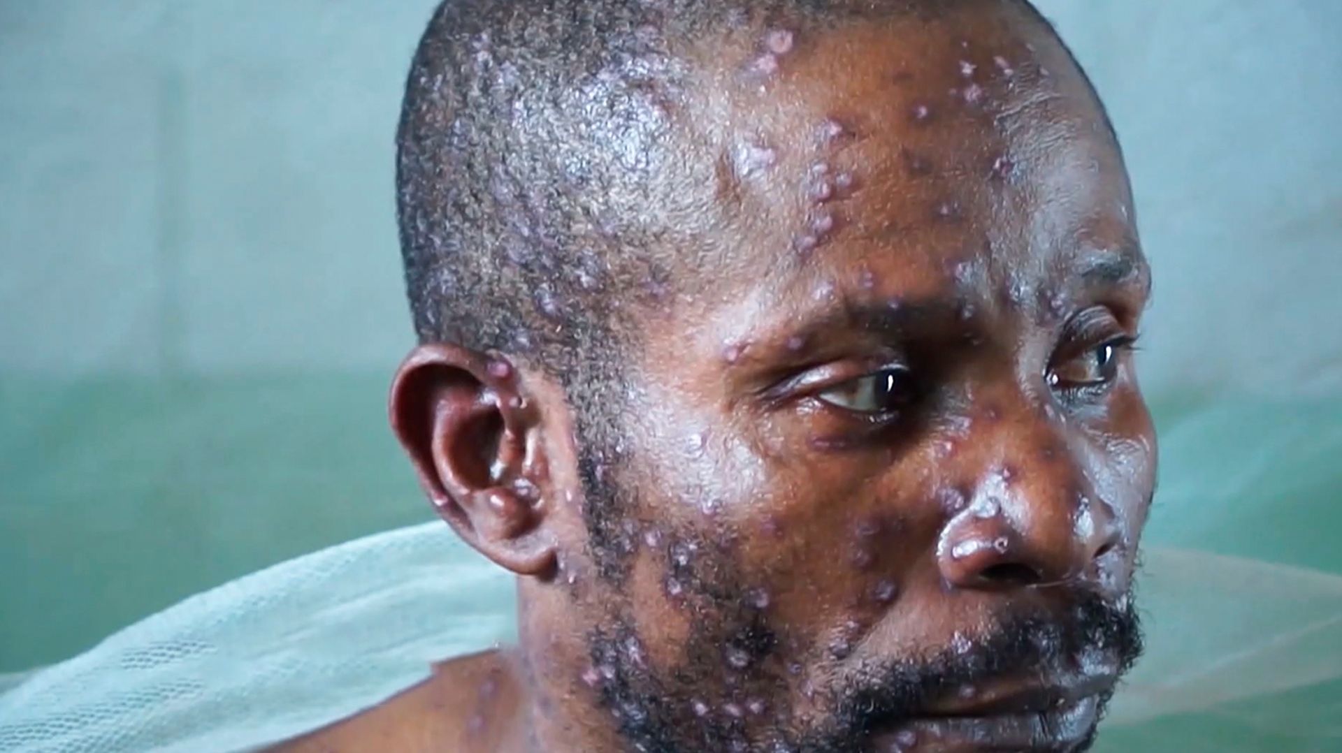 Оспа обезьян уже в России: чем опасна инфекция и возможна ли эпидемия? смотреть онлайн