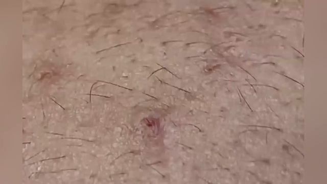 Выдавливание прыщей, угрей, черных точек и камедонов #102