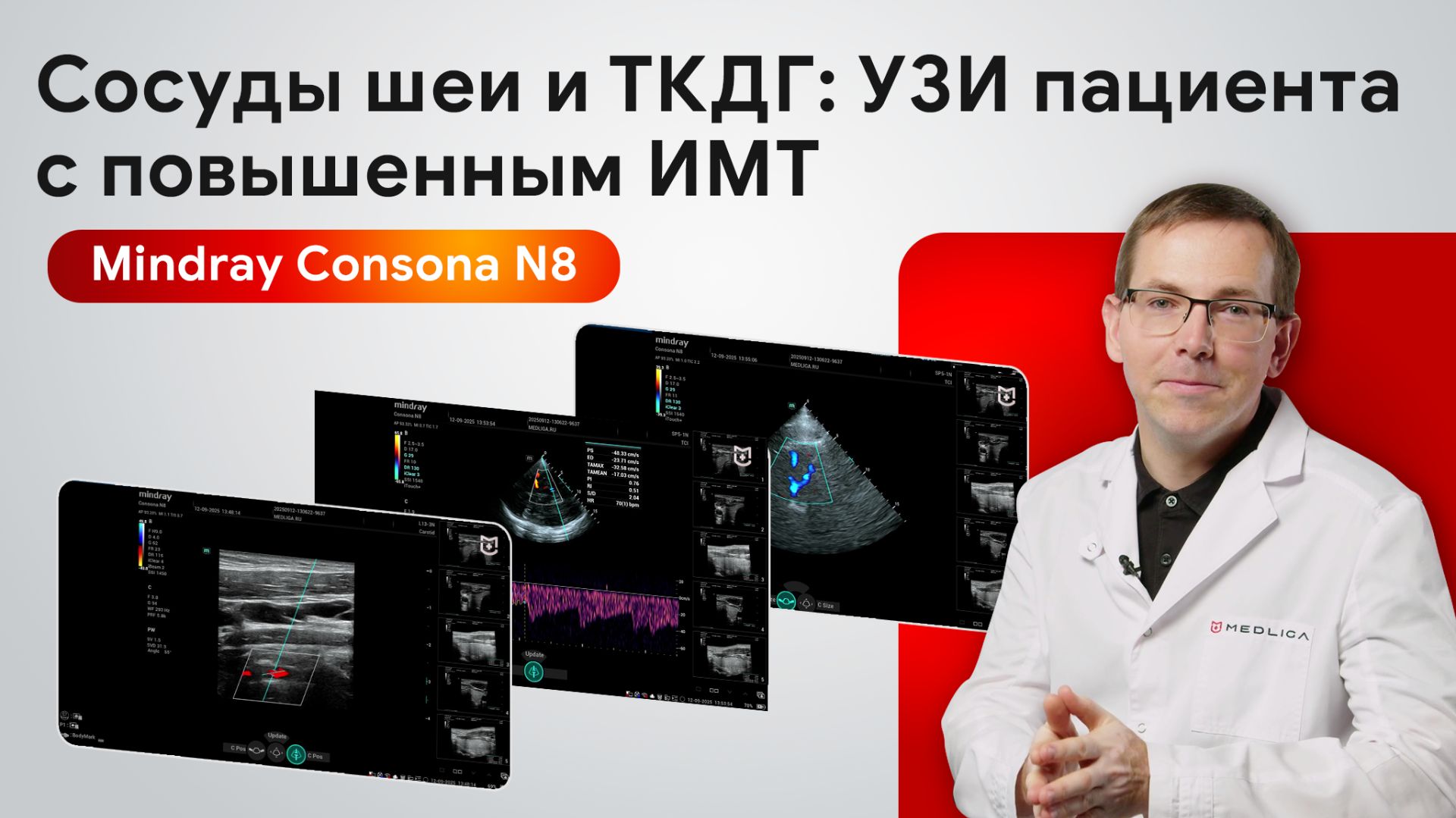 УЗИ сосудов шеи и ТКДГ у пациента с повышенным ИМТ на Mindray Consona N8 смотреть онлайн
