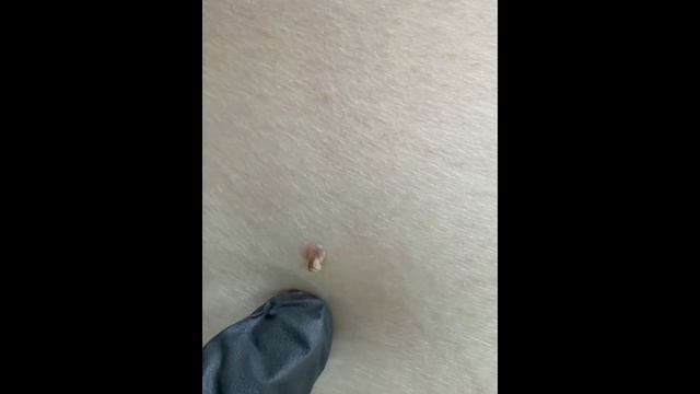 Удаление доброкачественных новообразований кожи электрокоагуляцией