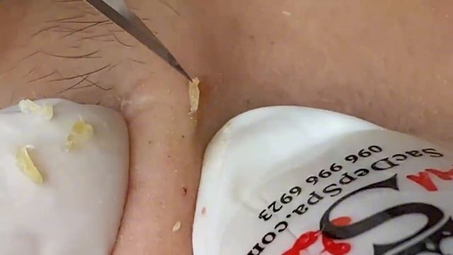 Выдавливание прыщей, угрей, черных точек и камедонов #103 смотреть онлайн