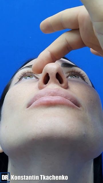 Ринопластика + эндоскопическая подтяжка лба