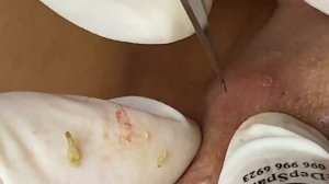 Выдавливание прыщей, угрей, черных точек и камедонов #107