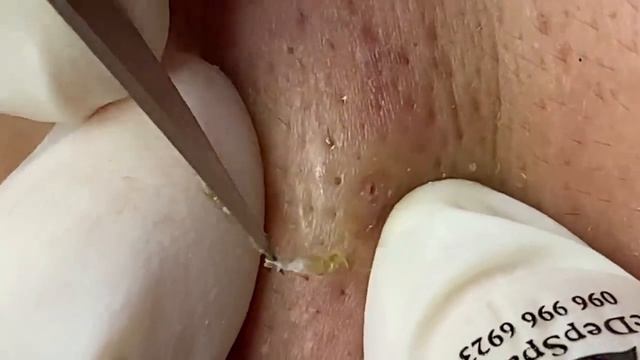 Выдавливание прыщей, угрей, черных точек и камедонов #106