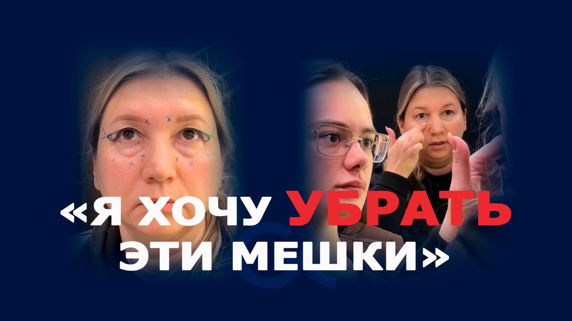 Круговая блефаропластика и миопексия: деликатная коррекция век