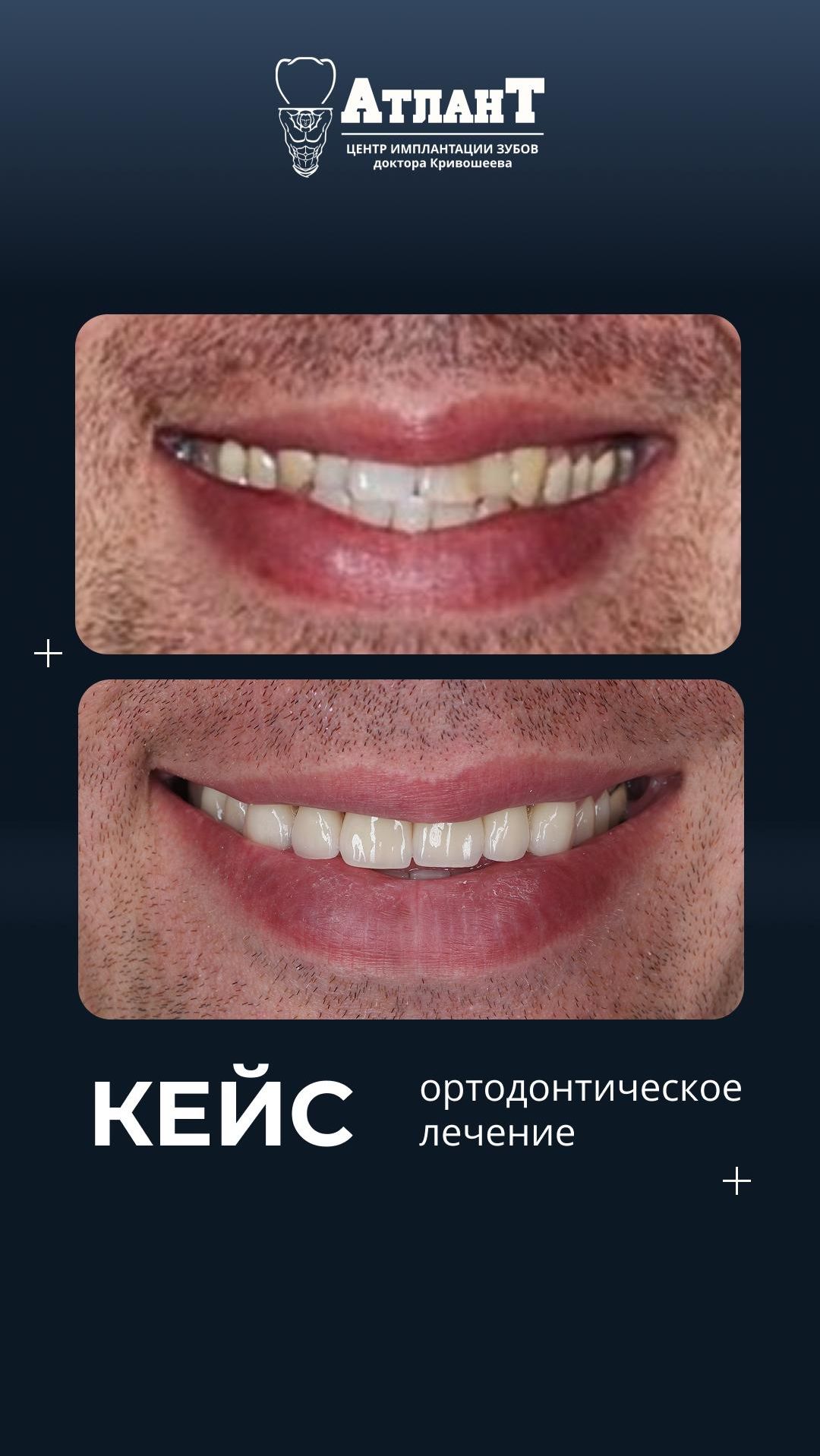 Исправление сложной зубо-челюстной аномалии (ортодонтия, гнатохирургия и протезирование) #shorts