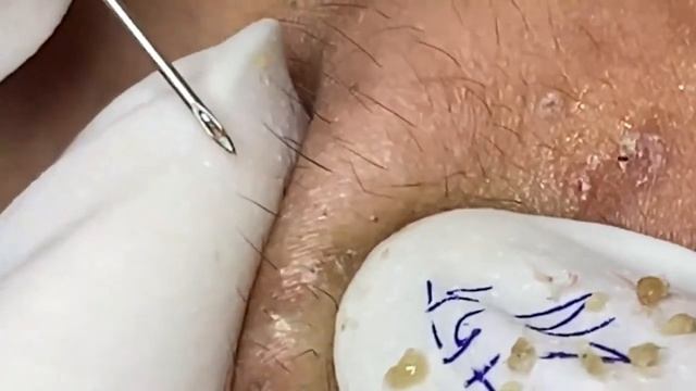 Выдавливание прыщей, угрей, черных точек и камедонов #108