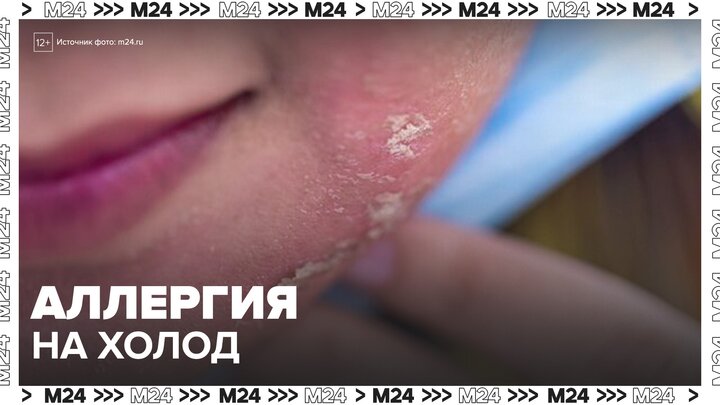 Москвичи столкнулись с аллергией на холод из-за аномальных морозов - Москва 24 смотреть онлайн