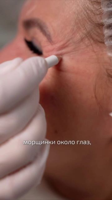 Ботулинотерапия по технике Full Face