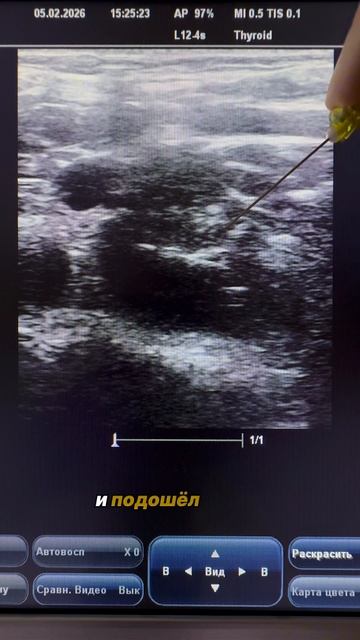 НОВЫЙ ЛАЙФХАК ПРИ ПОСТАНОВКЕ ЦВК узинавигация сосудистыйдоступЦВК