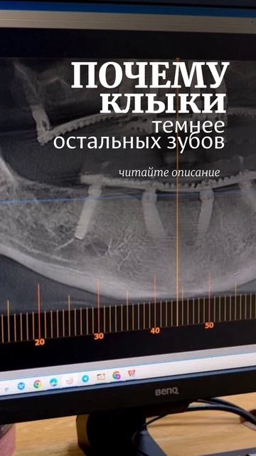 Почему клыки темнее других зубов