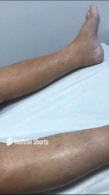 Тактика работы с лимфостазом ног