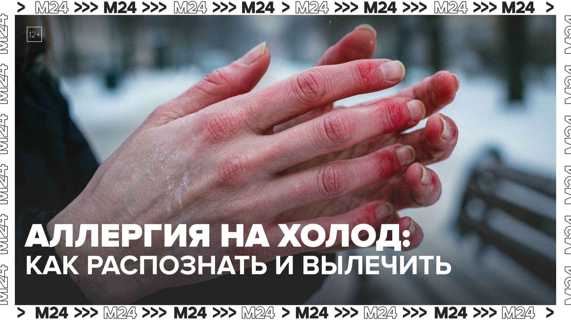 Как распознать аллергию на холод? — Москва 24 смотреть онлайн