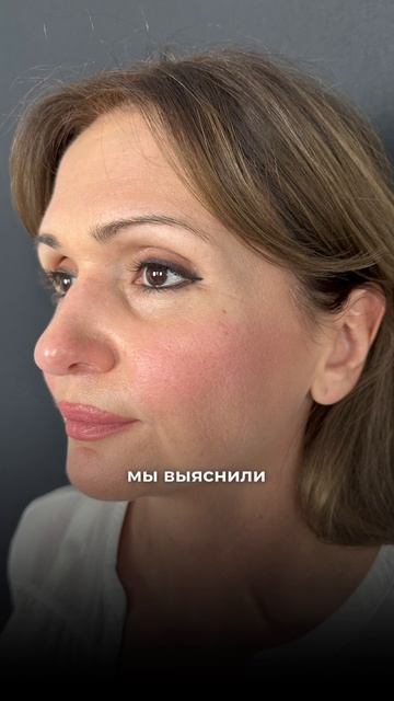 Классическая блефаропластика смотреть онлайн