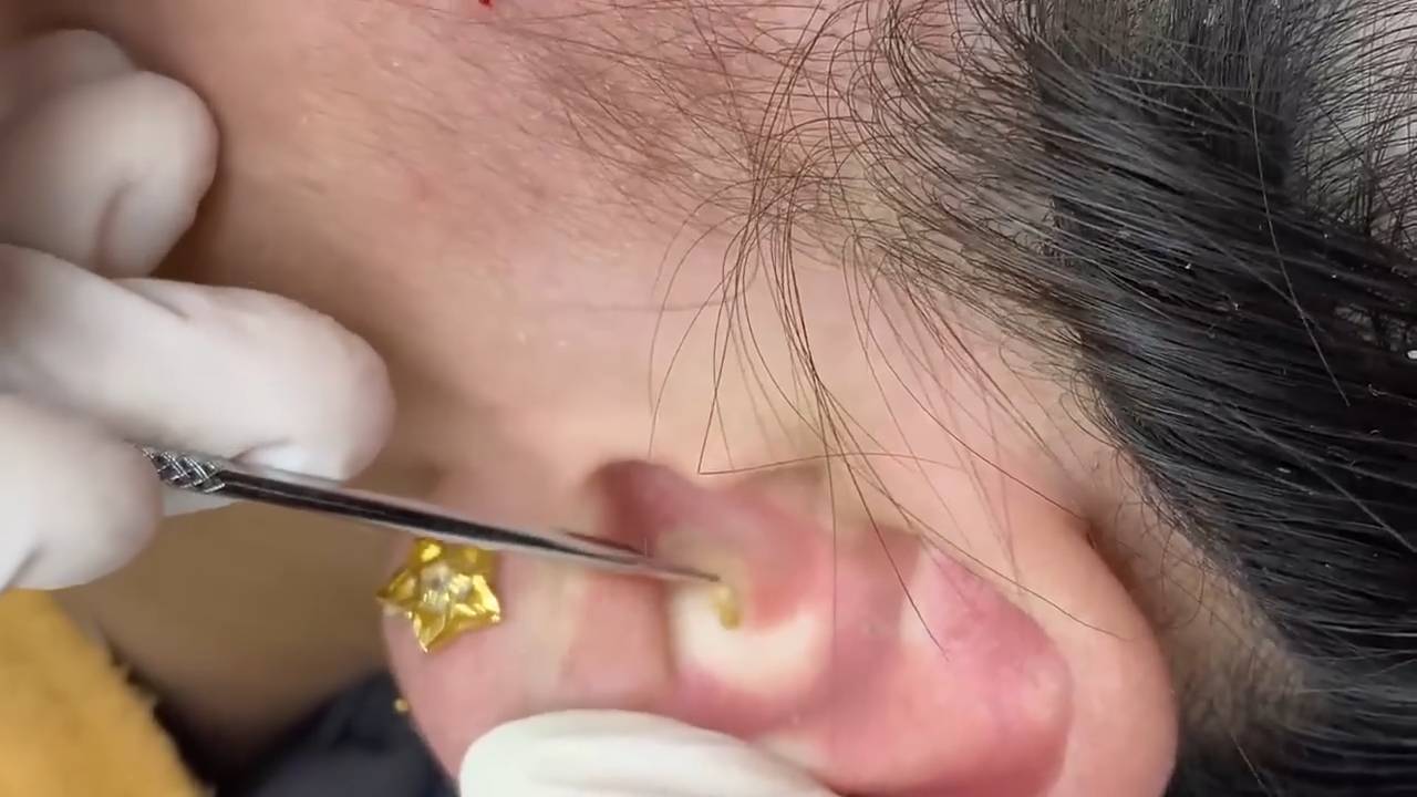 Выдавливание прыщей, угрей, черных точек и камедонов #113