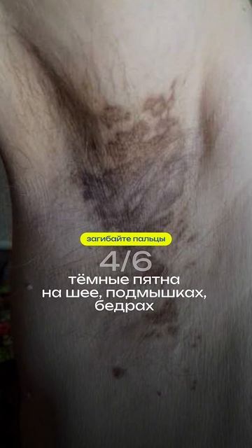 Эти симптомы кричат– у вас инсулинорезистентность⛔️