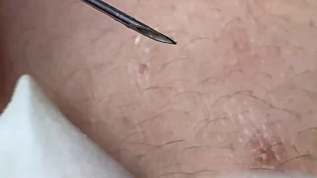 Выдавливание прыщей, угрей, черных точек и камедонов #111