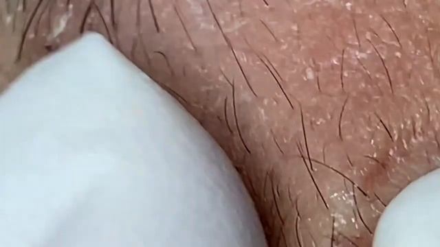 Выдавливание прыщей, угрей, черных точек и камедонов #114