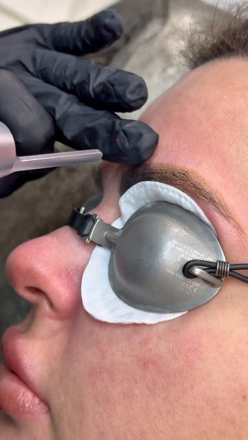 Как проходит процедура удаления татуажа бровей. Читай описание ❤️