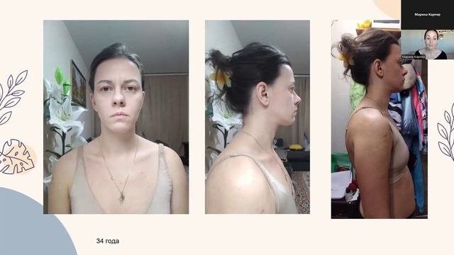 Запись эфира «Лифтинг лица»