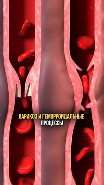 Почему вас снова образовывается варикоз?