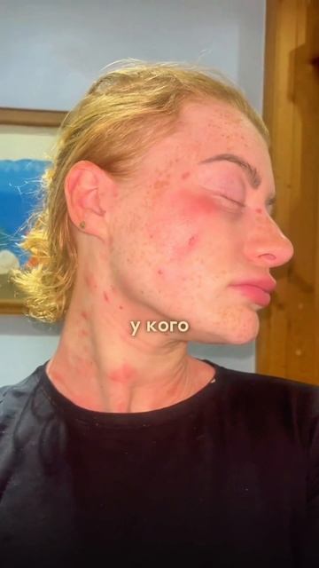 Псориаз, аллергия и кандидоз.Хочешь восстановить организм? Свяжись со мной по ссылке в шапке