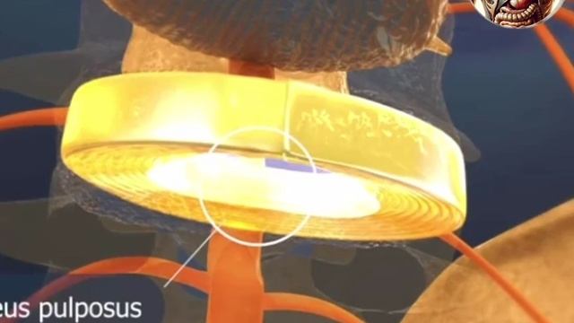 Межпозвоночная грыжа