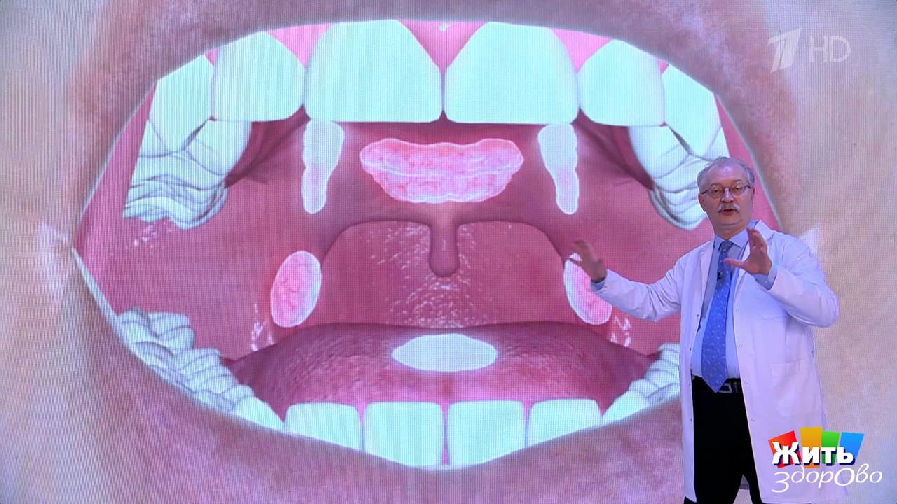 Ангина: лечим правильно - без осложнений. Жить здорово! Фрагмент выпуска от 30.01.2026 смотреть онлайн