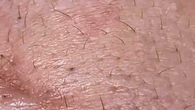 Выдавливание прыщей, угрей, черных точек и камедонов #119 смотреть онлайн